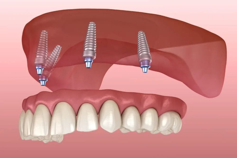 Can I Eat Normally with Implant Dentures? Foods to Enjoy and Avoid