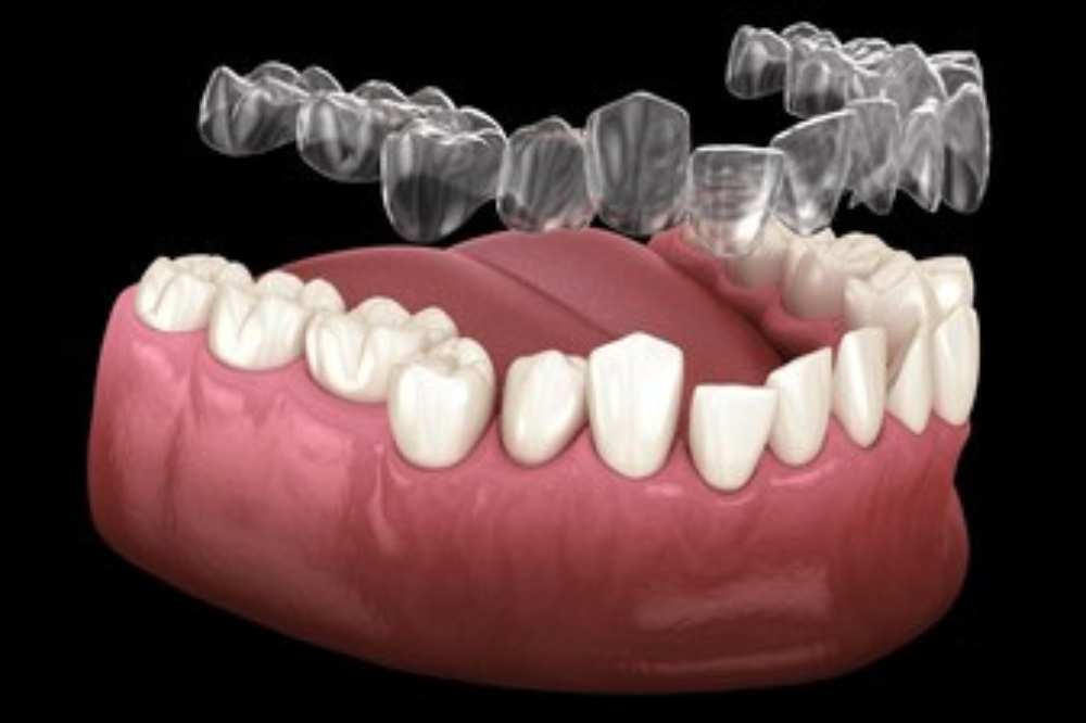 Invisalign Clear Aligners: A Modern Alternative to BracesInvisalign Clear Aligners: A Modern Alternative to Braces