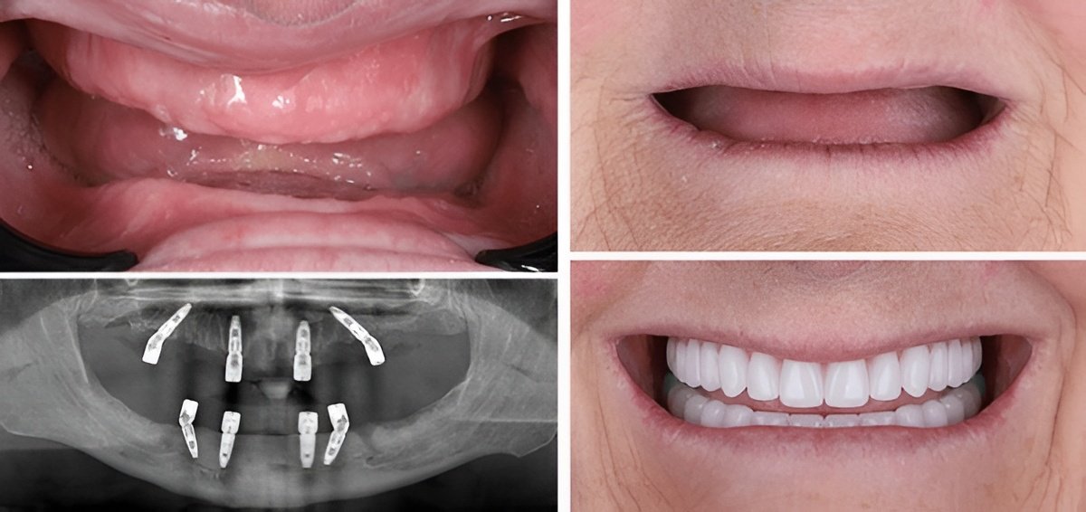 all on x dental implants in vancouver all on x dental implants in vancouver