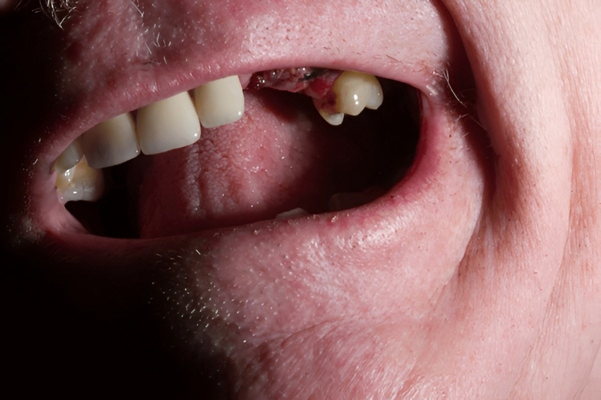failed or failing dental implants treatment in vancouver failed or failing dental implants treatment in vancouver