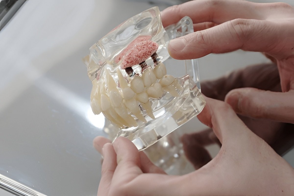 sinus grafting in vancouver sinus grafting in vancouver