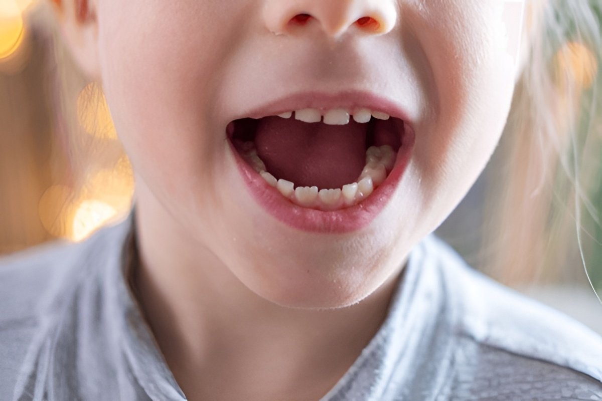 teeth in a day in vancouver teeth in a day in vancouver